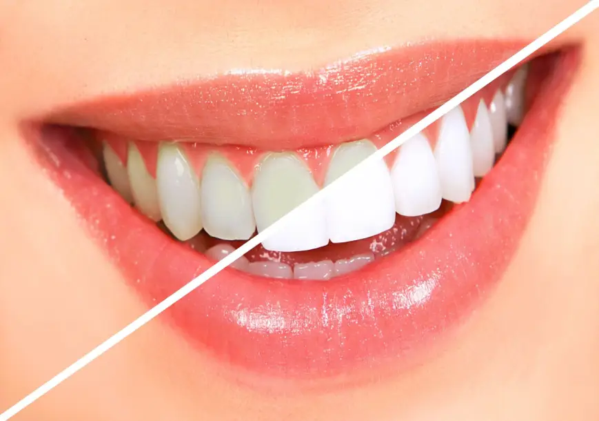 dental services in indore at tooth mentor dental clinic